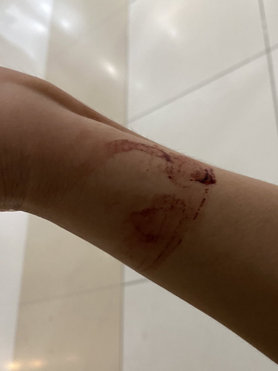 toonasteak's tweet photo. Hello @IamMakatiMed, grabe po humugot ng IV needle yung nurse nyo. Bigla na lang sumirit yung dugo ko and nalagyan pa yung hoodie ko.

Hindi ko alam kung may lakad ba s’ya at nakalimutan nya agad ilagay yung tape. https://t.co/GeBvW078KH