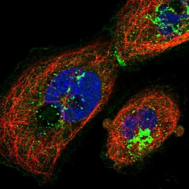 BiogenBR's tweet photo. ESTA PROTEÍNA PODE PROTEGER CONTRA O ALZHEIMER

DOI: 10.3390/cells12172143
Credibilidade: 959
#Alzheimer

Na busca por um tratamento para a doença de Alzheimer, os pesquisadores se concentraram em uma proteína com efeitos protetores.

Um novo estudo revela como o colesterol e a inflamação em diferentes tipos de células cerebrais humanas interagem com uma proteína chamada ABCA7, que regula a forma como as moléculas passam através das membranas celulares.

Níveis reduzidos de ABCA7 nas células cerebrais humanas podem ser um gatilho para a doença de Alzheimer, e a equipe acredita que suas novas informações poderiam ser usadas para desenvolver tratamentos.

“Mostramos que a depleção do colesterol reduz os níveis de ABCA7 na micróglia e nos astrócito humanos, mas não nas células neuronais”, escreve a equipe do Centro de Alzheimer da Universidade Temple, na Filadélfia.

Pesquisas anteriores realizadas por dois dos autores do presente estudo descobriram que os níveis cerebrais de ABCA7 diminuem com a idade e que as pessoas com níveis mais baixos têm maior probabilidade de desenvolver a doença de Alzheimer mais cedo na vida.

Isso se baseou em descobertas sobre variantes genéticas do ABCA7 em pacientes com doença de Alzheimer em estudos de associação de todo o genoma com milhares de participantes.

“Mas os estudos do genoma apontam apenas para uma proteína e não nos dizem nada sobre como ela funciona ou como afeta uma doença”, diz o neurocientista Joel Wiener.

“Nosso objetivo é revelar as funções do ABCA7 e usar o que aprendemos sobre seu papel na patologia para transformá-lo em uma terapia eficaz contra a doença de Alzheimer”.

O colesterol e a inflamação crónica têm sido implicados na doença de Alzheimer, mas não sabemos muito sobre estes dois fatores.

A inflamação ajuda a combater infecções e a curar tecidos danificados, mas é um processo complexo. A inflamação crônica pode danificar tecidos e órgãos saudáveis e levar a sérios problemas de saúde.

Em nossos cérebros, as células imunológicas chamadas microglia regulam principalmente a inflamação, embora as células de suporte chamadas astrócitos também desempenhem um papel, juntamente com os neurônios.

Weiner e colegas realizaram uma série de experimentos em micróglia humana, astrócitos e linhas celulares de neurônios cultivadas em laboratório. Depois de remover parte do colesterol, trataram as células cerebrais com rosuvastatina, um medicamento que inibe a produção de colesterol.

Quando cerca de metade a três quartos do colesterol normal foi removido das células, os níveis de ABCA7 diminuíram cerca de 40% nas linhas celulares de microglia e cerca de 20% numa linha celular de astrócito.

Em seguida, os investigadores administraram três citocinas diferentes – pequenas proteínas desencadeadoras de inflamação, segregadas pelas nossas células imunitárias – às linhas de células cerebrais.

Na microglia, duas das citocinas suprimiram a expressão de ABCA7, e a terceira citocina não mostrou nenhum impacto em ABCA7. Nenhuma das três citocinas induziu quaisquer alterações nos níveis de ABCA7 em astrócitos ou neurônios.

“No geral, a depleção do colesterol e a inflamação podem reduzir os níveis de ABCA7 no cérebro e causar o aparecimento da doença de Alzheimer”, diz Wiener.

É possível que a perda de ABCA7 na doença de Alzheimer seja devida a uma mudança abrupta no metabolismo do colesterol ou a uma resposta inflamatória.

A equipe afirma que seus resultados apoiam a ideia de que o ABCA7 mantém o equilíbrio lipídico no cérebro, eliminando o colesterol que pode danificar as células nervosas. Mas a inflamação parece diminuir temporariamente os níveis de ABCA7, o que pode se tornar um problema quando a inflamação não resolve.

Isto pode explicar porque é que as pessoas com esclerose múltipla, que envolve níveis elevados de citocinas inflamatórias, têm maior probabilidade de desenvolver a doença de Alzheimer.

“O maior desafio agora é descobrir como medir os níveis de ABCA7 no cérebro dos seres humanos vivos”, explica o neurocientista Nicholas Lyssenko.
...
https://t.co/LWCZ63UDZc