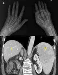 HilosMedicos's tweet photo. 12/ 🔺 Triada de Felty:

Reumatismo
Esplenomegalia
Neutropenia 

👉Diagnóstico: Síndrome de Felty https://t.co/YAMGePJh1d