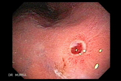 HilosMedicos's tweet photo. 13/ 🔺 Triada de Dieulafoy:

Hematemesis
Shock
Sin evidencia de úlcera en endoscopia 

👉Diagnóstico: Lesión de Dieulafoy https://t.co/pAG9u46dVj