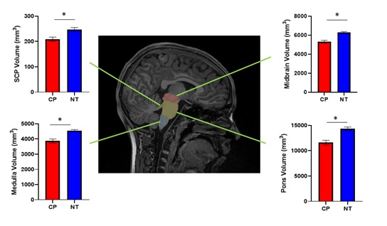 Our latest results show that alterations in the brainstem are connected with the mobility impairments seen in persons with #CerebralPasly tinyurl.com/mr2484h8