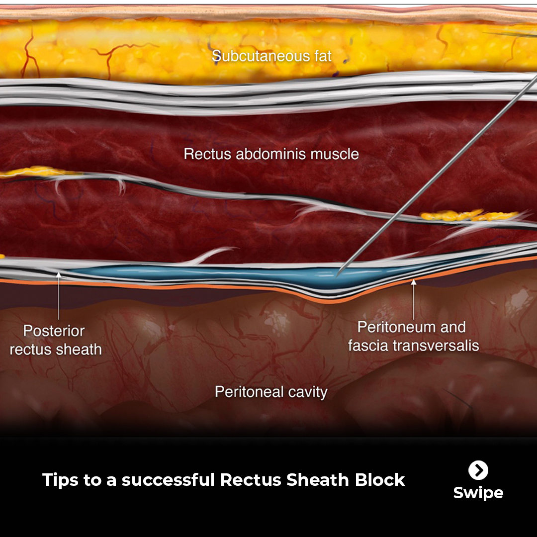 Lower Extremity Nerve Blocks Poster (in) – NYSORA