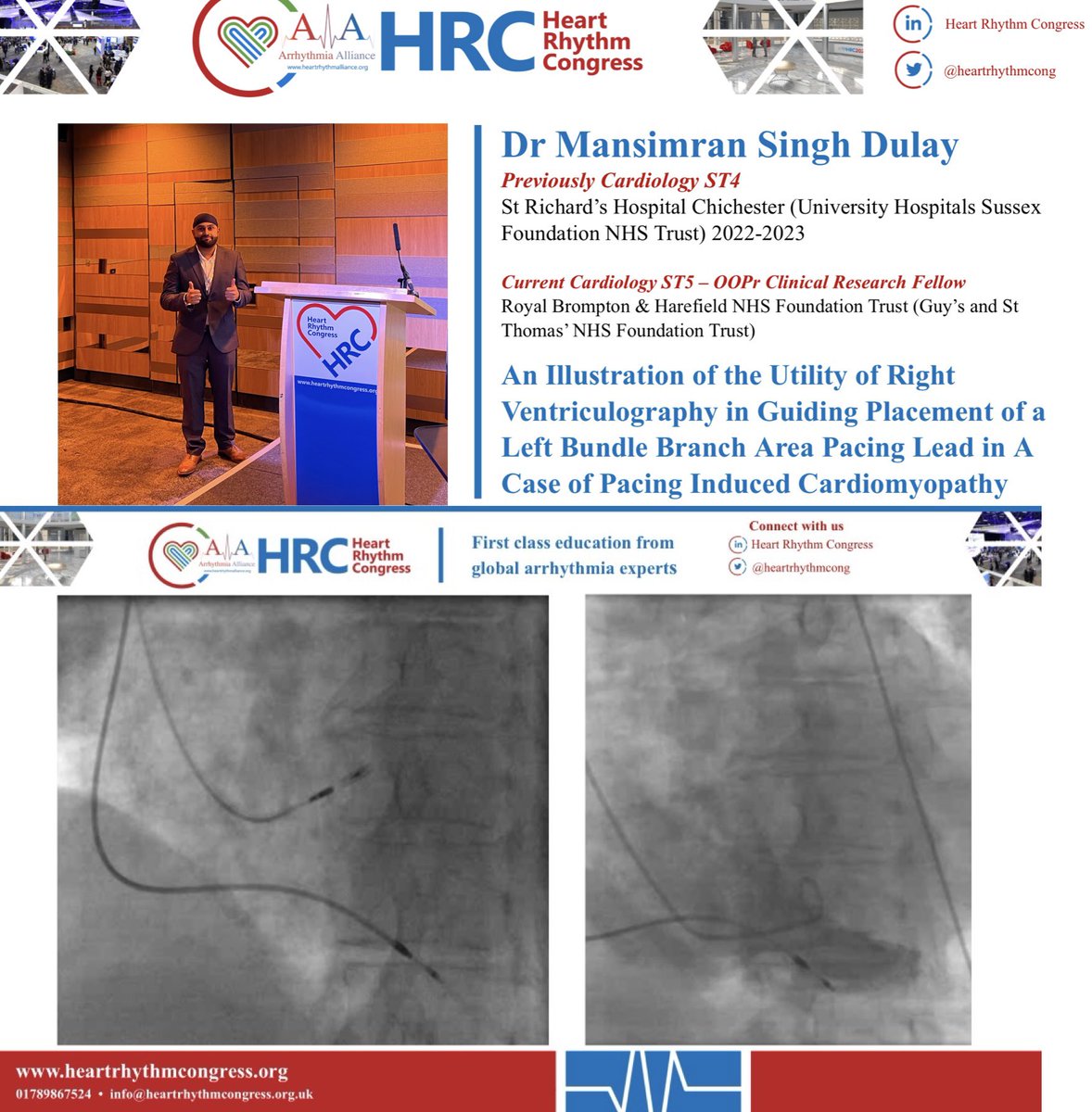 drmarktanner1's tweet photo. Fantastic #HRC2023 Cases &amp; Traces session this morning @heartrhythmcong. Great work from the St Richard’s cardiology team @UHSussex. Congrats to Mani who elegantly  illustrates the utility of ventriculography in Conduction System Pacing lead placement. Bravo! https://t.co/jYoYSbCyU6