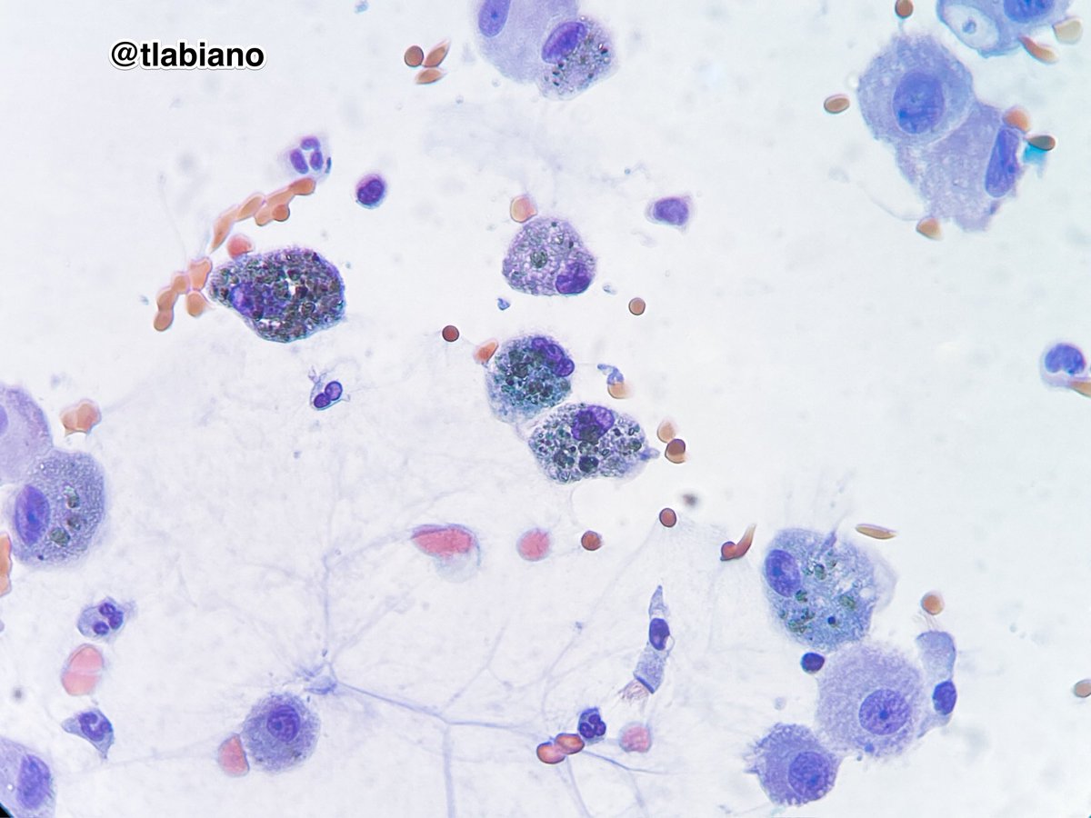 tlabiano's tweet photo. 💦🫁🔬Bronchioalveolar lavage (BAL) #cytoloyy; patient with hemophilia , hemoptisis, and diffuse lung infiltration.
🔬🤎💙 Hemosiderin-laden alveolar macrophages (siderophages) #PerlsPrussianBlue #cytopath #cytotechnicians https://t.co/d7kJMOJI8E