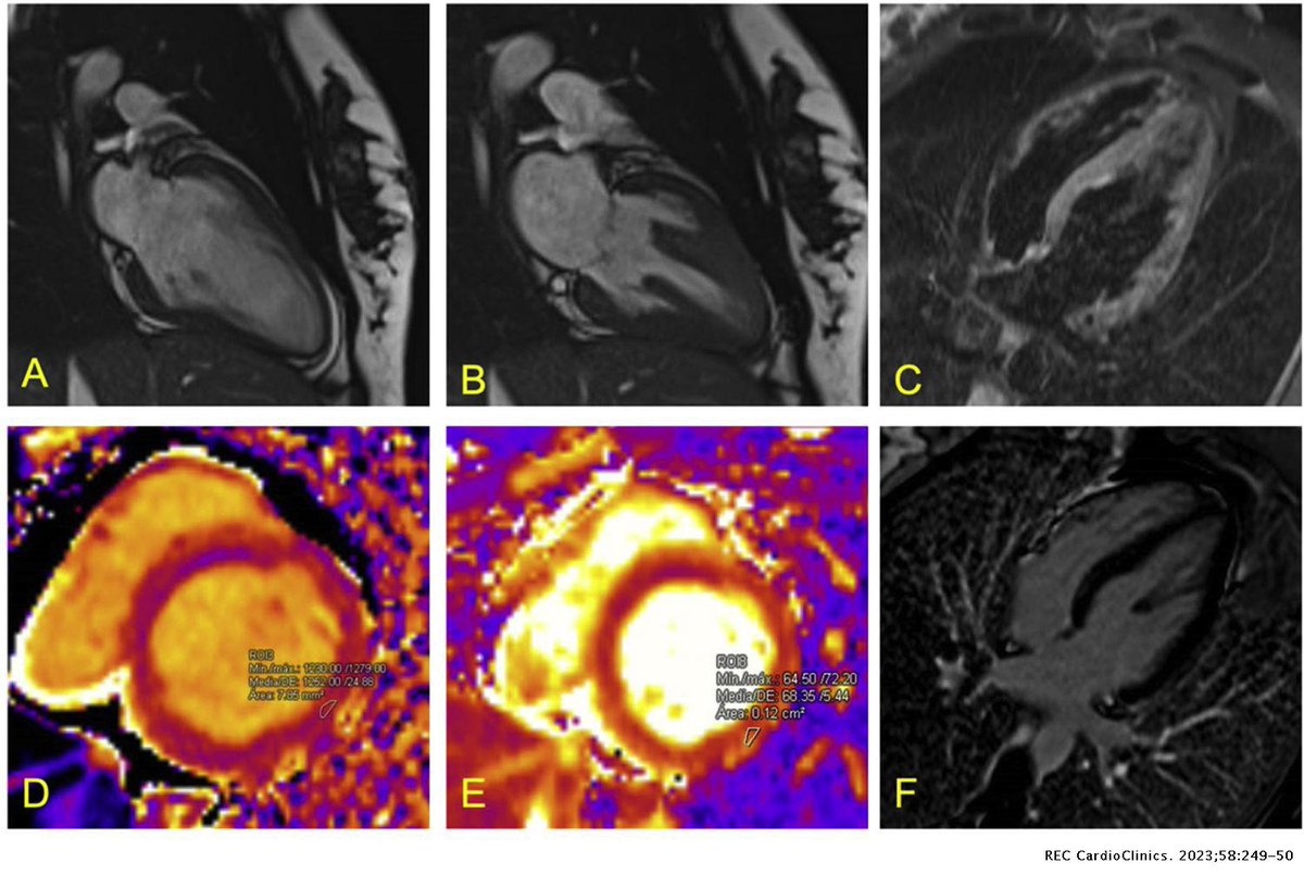 REC Publications (@revespcardiol) on Twitter photo Periparto y shock cardiogénico: valor de imagen avanzada #reccardioclinics #Imagen #Cardiotwitter <a href="/ConsueloFA1/">Consuelo Fernández-Avilés</a> <a href="/piserraggs/">Alberto Piserra López</a> <a href="/FranJHidalgo/">Francisco Hidalgo</a> <a href="/Cardio_HURS/">CardioHURS</a>
reccardioclinics.org//es-periparto-… Periparto y shock cardiogénico: valor de imagen avanzada #reccardioclinics #Imagen #Cardiotwitter <a href="/ConsueloFA1/">Consuelo Fernández-Avilés</a> <a href="/piserraggs/">Alberto Piserra López</a> <a href="/FranJHidalgo/">Francisco Hidalgo</a> <a href="/Cardio_HURS/">CardioHURS</a>
reccardioclinics.org//es-periparto-…