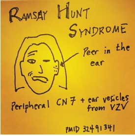 #EPs about to diagnose patients w/ uncomplicated #Bellspalsy shouldn’t forget to peer in their #ear, says @M_Lin. Look for a #vesicular #rash from #varicellazoster #virus #VZV around & in the ear. Just ask @justinbieber who had it in 2022. #FOAMed tinyurl.com/23haz6s5