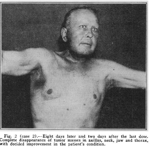 WashUOncology's tweet photo. The first chemotherapy drug approved by the FDA was nitrogen mustard in 1946.
@WUHemeOncFellow @HemOncFellows
#nhlsm #hlsm #leusm
https://t.co/93kWd87yeA https://t.co/cfbLXC9UVc