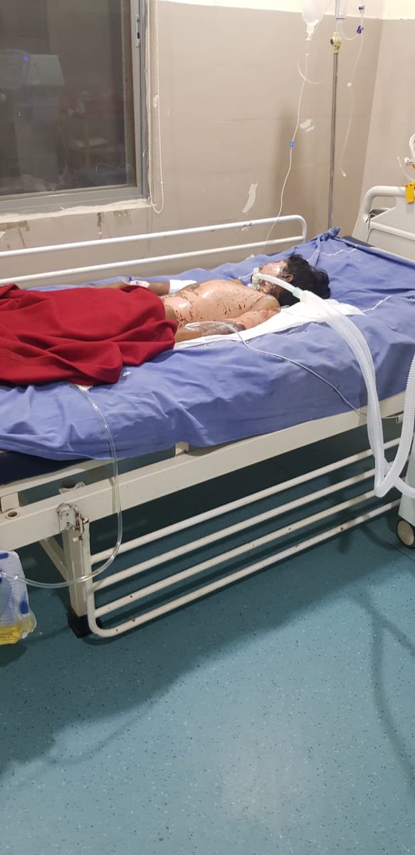 Amishi_1902's tweet photo. Medical Emergency🚨
Sir need your help to save the child from severe electrical burns🙏🏼
Name: Ankit Kumar
Hospital: Wellness hospital dharam karam road, Ameerpet
Contact: 8149948776
@TelanganaCMO @BRSHarish @KTRBRS
@BRSparty @BrsSabithaIndra
#Hyderabad #MedicalHelp #help https://t.co/6kAbG6dTLn