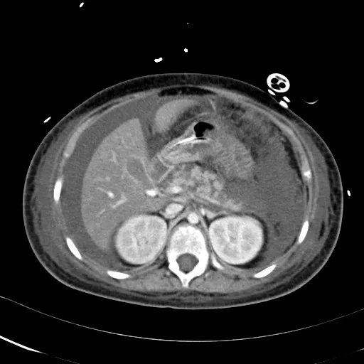 radRounds's tweet photo. Patient recently started on multiple new medications who presents w abdominal pain, elevated lipase, peripancreatic fluid collections, and hypodense areas within the pancreas? Diagnosis? Answer = https://t.co/FrIVR2Hwqa https://t.co/JamlZWGZDE