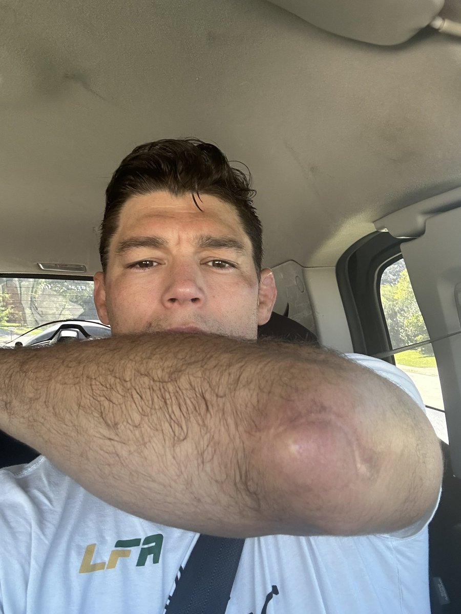 AlanJouban's tweet photo. Did Costa say what that surgery was from? Because it looks like bursitis where they removed it. I’ve got the same scar. And I tried coming back too soon and opened the whole thing up and had to have it re-stitched three weeks later. https://t.co/gAXphINM2s