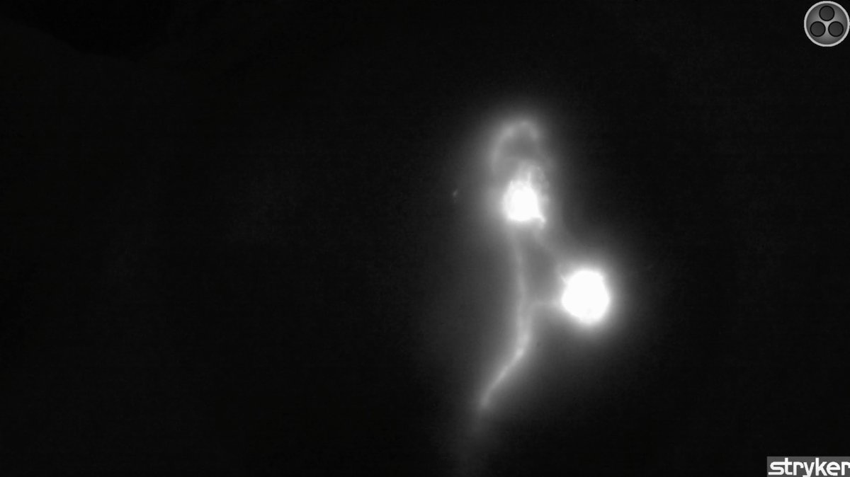StrykerEndo's tweet photo. Stryker’s SPY-PHI System & SPY AGENT GREEN can aid surgeons in the visualization of lymphatic channels draining into the lymph nodes of the axilla in adults with #BreastCancer. This is the only system & imaging agent on label for #LymphaticMapping in breast cancer.
*Data on file https://t.co/aasCQSyu1N