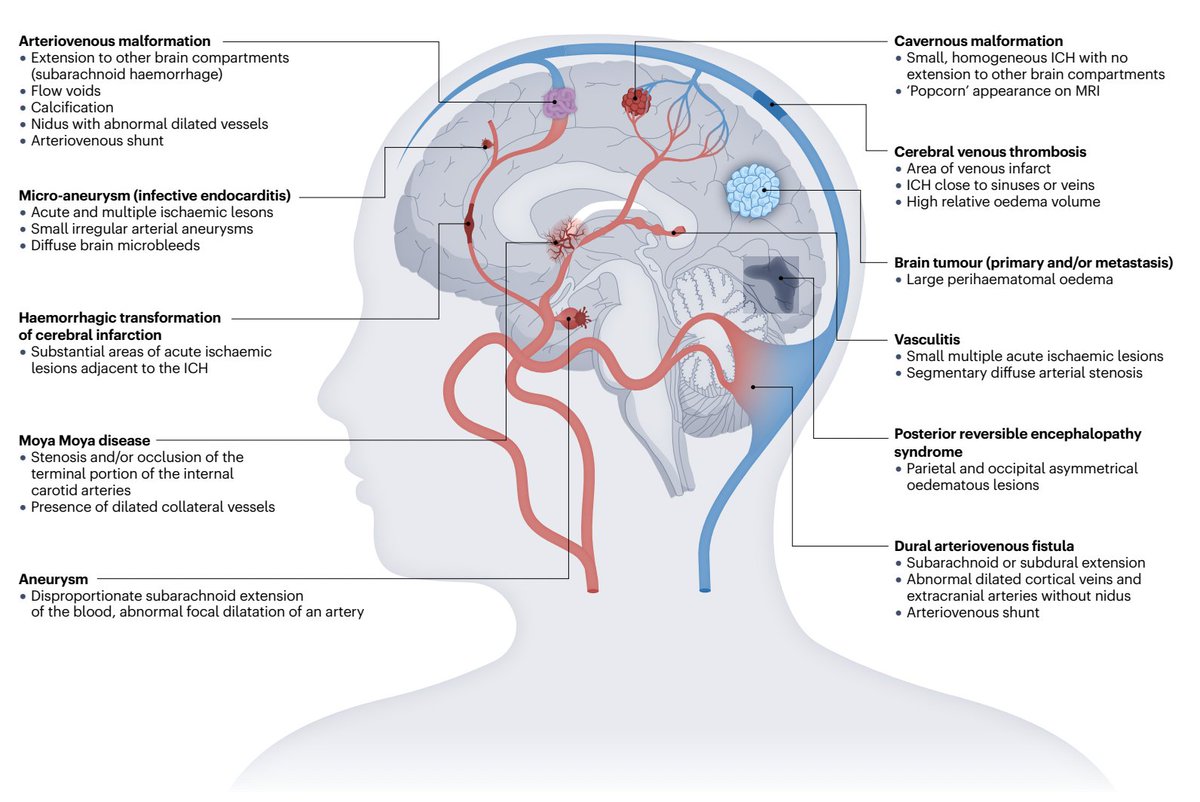 🩸🧠Treatable causes of intracerebral haemorrhage

⭕️ Several macrovascular disorders
 🗝️Key features seen on brain MRI and/or CT
💡 Clues for diagnosis

via: @DiseasePrimers

#neurotwitter #NeuroTwitter #NeuroRad #MedTwitter #MedStudentTwitter #MedEd #EndNeurophobia #Neurology