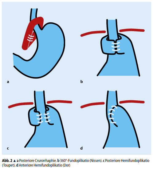 MA__Schneider's tweet photo. Have a look at our latest article giving an overview of the current surgical treatment options for reflux disease (article in german & french):
➡️https://t.co/JwXzzKwztt
#SoMe4Surgery #MedTwitter #SurgEd #surgery
#some4UGI #uppergi #reflux https://t.co/qLmBcjvqDj