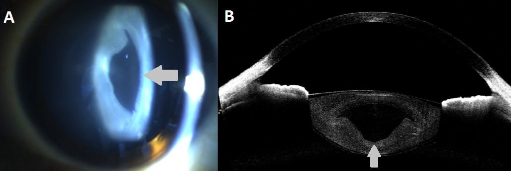 AAOjournal's tweet photo. Dicotylédones dans les yeux. Pediatric developmental cataract in a nine year female. (A) An irregular optically clear zone seen in the fetal and embryonic zone of the nucleus (looked like a cotyledon of a germinating seed). Imaged on the ASOCT (B). @tweetsavleen @manchanda1995 https://t.co/Z3jbM0LOnY