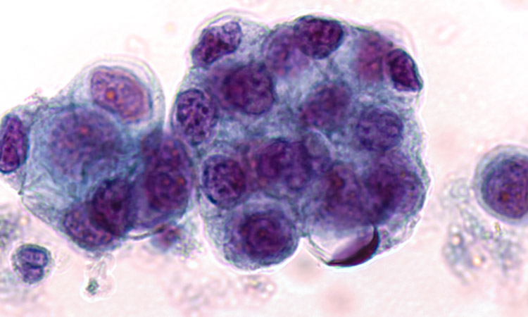 Sanford Burnham Prebys (@sbpdiscovery) on Twitter photo Sanford Burnham Prebys scientists suggest a new strategy to trick pancreatic tumors into death by feeding them a copycat of an important nutrient which starves them of the fuel necessary for survival. Read more: bit.ly/3ZRWwDd <a href="/Cosimo_Commisso/">Cosimo Commisso</a> Sanford Burnham Prebys scientists suggest a new strategy to trick pancreatic tumors into death by feeding them a copycat of an important nutrient which starves them of the fuel necessary for survival. Read more: bit.ly/3ZRWwDd <a href="/Cosimo_Commisso/">Cosimo Commisso</a>
