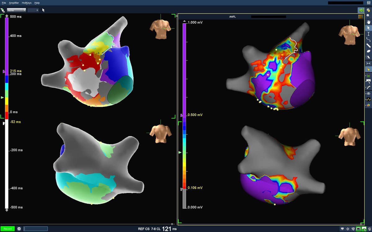 cstumpflEP's tweet image. #AtypicalFlutter LAT vs Voltage maps.