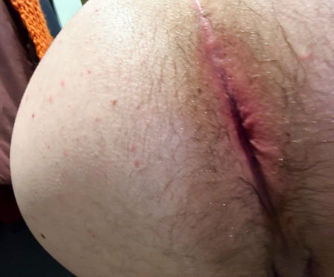 I just got my ass bred by a much older man and he was very rough. I&rsquo;m still dealing with anal pain, but