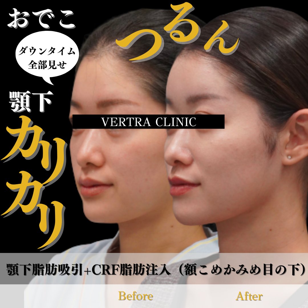 mone_p_'s tweet photo. ヴェルトラクリニックで顎下脂肪吸引して1年経ったけど、人生史上最強コスパ施術だった。ボコつきも無いし吸引時の傷跡も消えた。顎下しか吸って無いけど顔全体が小さくなった気がする🥺写真も動画も盛れるから下向くのも怖くない。やってなかったら確実に後悔する。しいて言うなら糸リフトも一緒に https://t.co/YVq9Vwwk4t