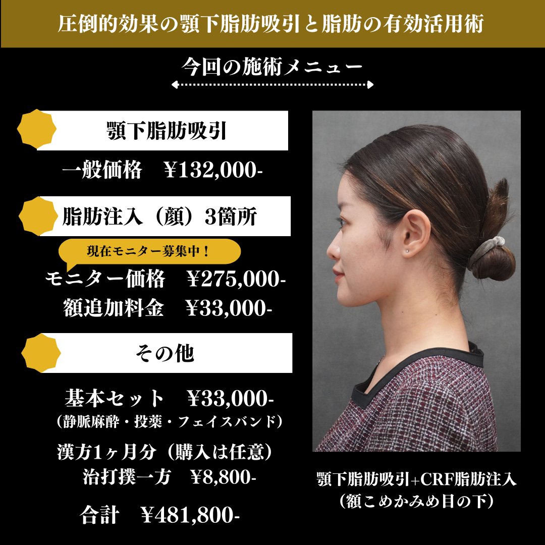 mone_p_'s tweet photo. ヴェルトラクリニックで顎下脂肪吸引して1年経ったけど、人生史上最強コスパ施術だった。ボコつきも無いし吸引時の傷跡も消えた。顎下しか吸って無いけど顔全体が小さくなった気がする🥺写真も動画も盛れるから下向くのも怖くない。やってなかったら確実に後悔する。しいて言うなら糸リフトも一緒に https://t.co/YVq9Vwwk4t