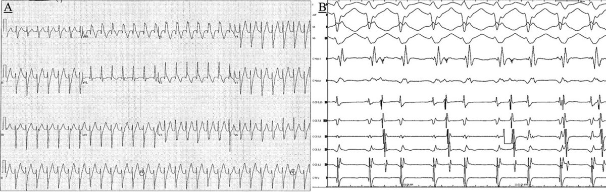 HRS_CaseReports's tweet photo. Using a Multi-electrode Catheter to Facilitate Mapping and Ablation of Idiopathic Fascicular Ventricular Tachycardia https://t.co/Hcr14cSSTJ https://t.co/Qvr3ubC66u