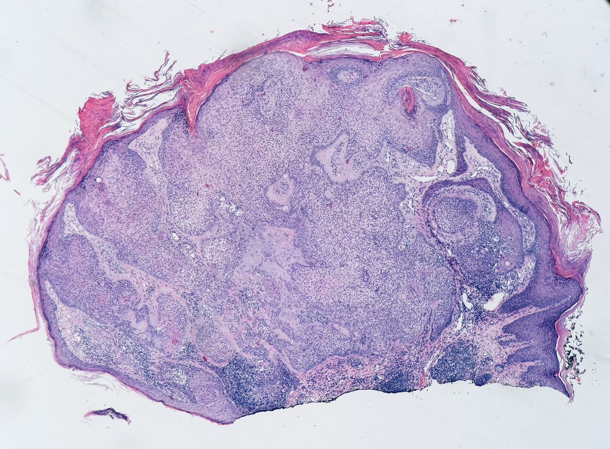 Daily Mundane for a #dermpath lover😊😂
<a href="/JacobSmalberger/">Jacob Smalberger, M.D.</a> <a href="/HoustonArsenal/">Jonathan He</a> <a href="/DrGeeONE/">Olaleke Folaranmi</a> <a href="/kis_lorand/">Lorand Kis</a> <a href="/pepeheffernan/">Pepe Jiménez Heffernan</a> @ArjunRamaiya1 <a href="/HansiniMD/">Hansini Laharwani</a> <a href="/TristanRutland7/">Tristan Rutland MBBS FRCPA IFCAP</a>