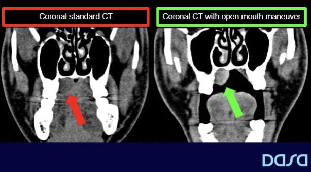 HNRadDASA's tweet photo. Be cautious with palate nodules on CT. Check out the importance of appropriate maneuver to highlight the lesion! #HNRAD https://t.co/xCDNphufpf