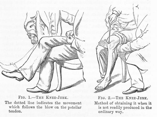 1/Birth of the Knee Jerk?
OTD 1879 William Gowers lectured on Diagnosis of Diseases of the Spinal Cord in Wolverhampton.15 pp of his subsequent monograph taught his audience how to elicit a knee jerk/tendon-reflex but his favored term was "myotatic contraction"
How did he do it?