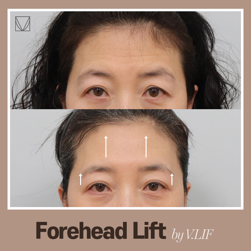 Natural #foreheadlift at V.LIF🧡 

Lift UP your #saggy eyelids to look 10 years younger✨ with our endoscopic forehead lift!

#foreheadwrinkles #droopyeyes #browlift