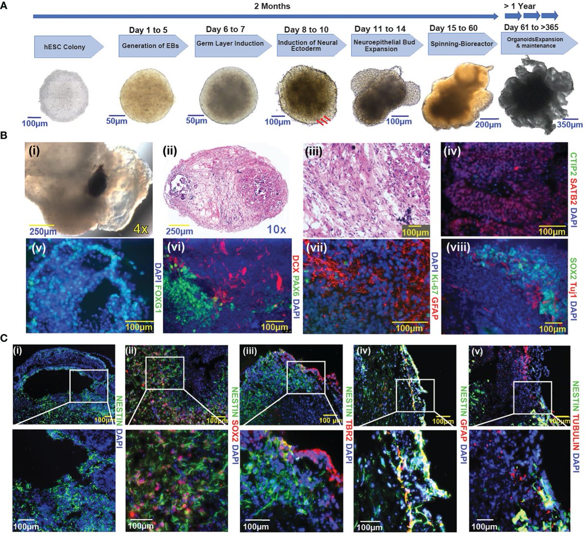 Check out the latest manuscript from @pascalzinn Lab in which we demonstrate how TP53-PTEN-NF1 depletion in human brain organoids produces a glioma phenotype. @rrcolen @NdukaAmankulor @Baoli_Hu @HameedFarrukh @PittNeurosurg frontiersin.org/journals/oncol…