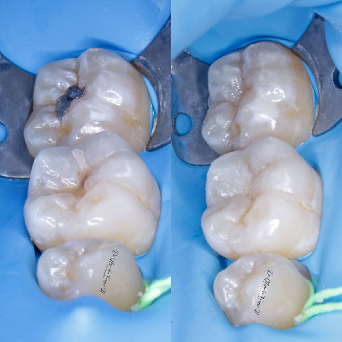 OvertoneDental's tweet photo. Las resinas deberían ser eternas 👌🍃 https://t.co/aBpgjdLh6y