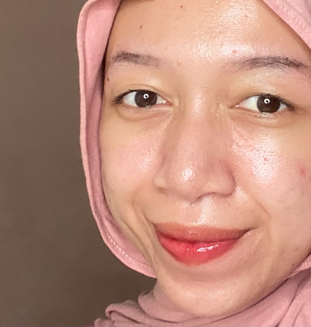 journeywithApr's tweet photo. life saver ngatasin jerawat &amp; komedo:

semenjak pake radiant serum udah gk mau pindah ke serum yang lain! kalo boleh bilang serumnya ajaib buat acne prone skin✨💯 https://t.co/hPxkhOcrj6
