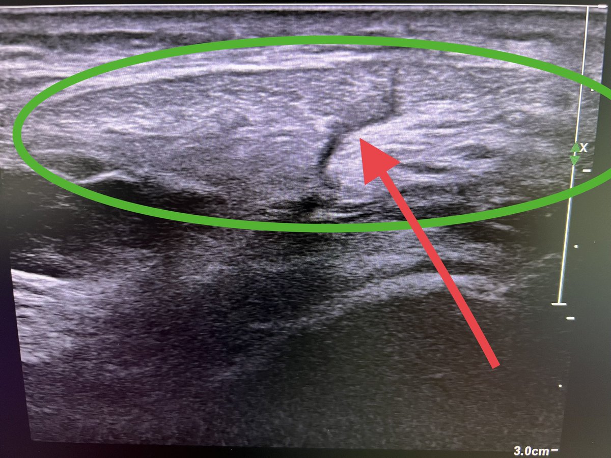 Seen a few patients post knee arthroscopy where a port has been put through the patella tendon (green oval) causing scarring (red arrow) pain, poor quad functx. 

Any advice on how to avoid this from our knee surgeons? 

Difficult to estimate width of PT from palpation alone.