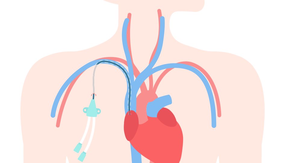 La_SRLF's tweet photo. #REACTU L’abord supra-claviculaire de la veine sous-clavière : le must des sites d’insertion des cathéters centraux veineux en réanimation ?
Découvrez l'analyse de l'article publié dans Annals of Intensive Care https://t.co/EHqu443lgk
@of_aic https://t.co/vufC5HVZ7N