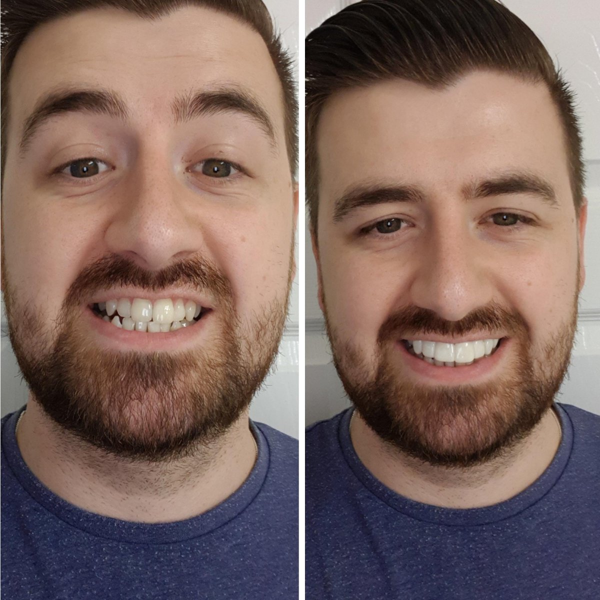 instasmile's tweet image. 😱 Check out this incredible before and after with instasmile clip-in veneers! 😍 Say goodbye to smile insecurities and hello to a flawless, million-dollar smile! 💎 💯💪 Don't wait any longer to unlock your true potential - it's time to shine bright with instasmile! ✨✨"