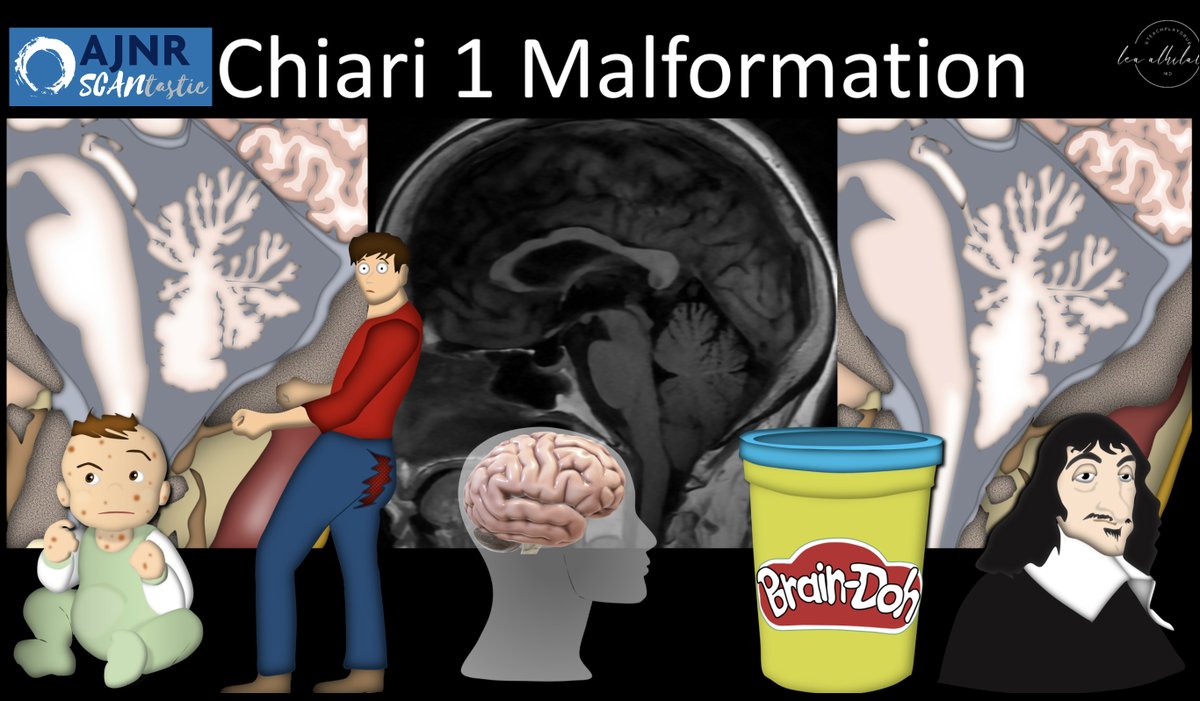 1/AJNR SCANtastic 🧵w/ <a href="/teachplaygrub/">Lea Alhilali, MD</a>!
 
Has measuring for Chiari 1 malformations become a real headache?

Can’t quite peg when to call a Chiari? Looking for a better way?

SCANtastic decompresses it w/new @theAJNR Chiari research: ajnr.org/content/early/…