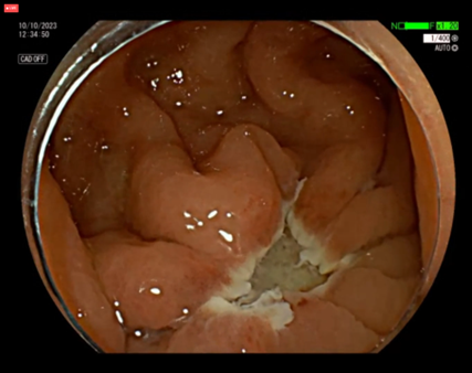 Dr Ahmir Ahmad (@drahmirahmad) on Twitter photo Underwater EMR performed beautifully by @NorikoSuzuki. This technique has been shown in a recent RCT to be as effective and safe as conventional EMR for large nonpedunculated colorectal lesions with the advantage of being faster and easier to perform <a href="/kentendosurgery/">KENT EndoSurgery Course</a> Underwater EMR performed beautifully by @NorikoSuzuki. This technique has been shown in a recent RCT to be as effective and safe as conventional EMR for large nonpedunculated colorectal lesions with the advantage of being faster and easier to perform <a href="/kentendosurgery/">KENT EndoSurgery Course</a>