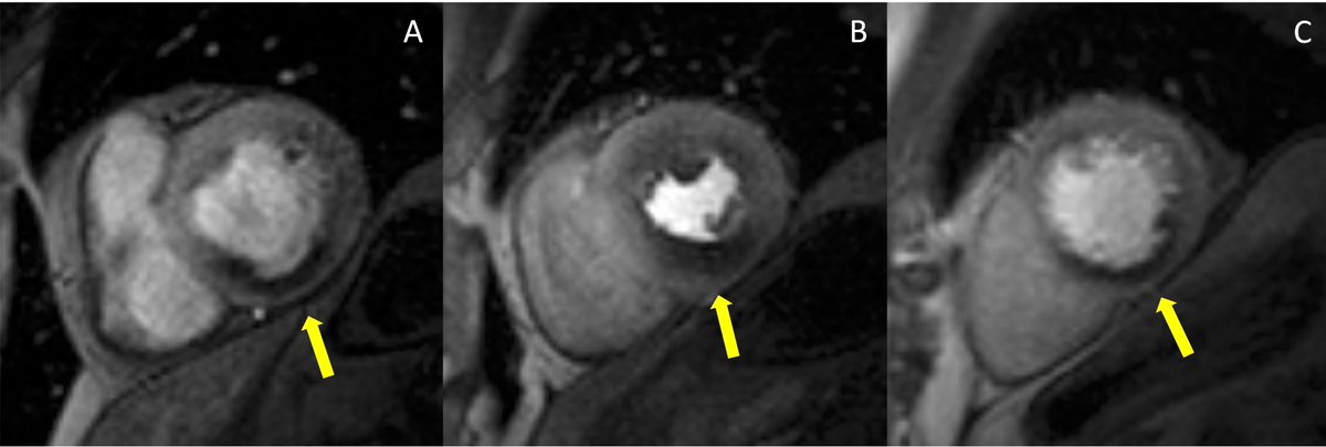RCMjournal's tweet photo. #RCM-Vol. 24 No. 9
🎨Review
Stress Cardiovascular Magnetic Resonance Imaging for the Detection of Coronary Artery Disease
🖍️from Giulia Vinco, @clementinadugo, @MarziaRigolli, @CriDematte, @jjtwetta et al.

#CMR #CAD #imaging #myocardial

🔔Full Text:
https://t.co/giDbgV8hwY https://t.co/XJIS9V2r2t