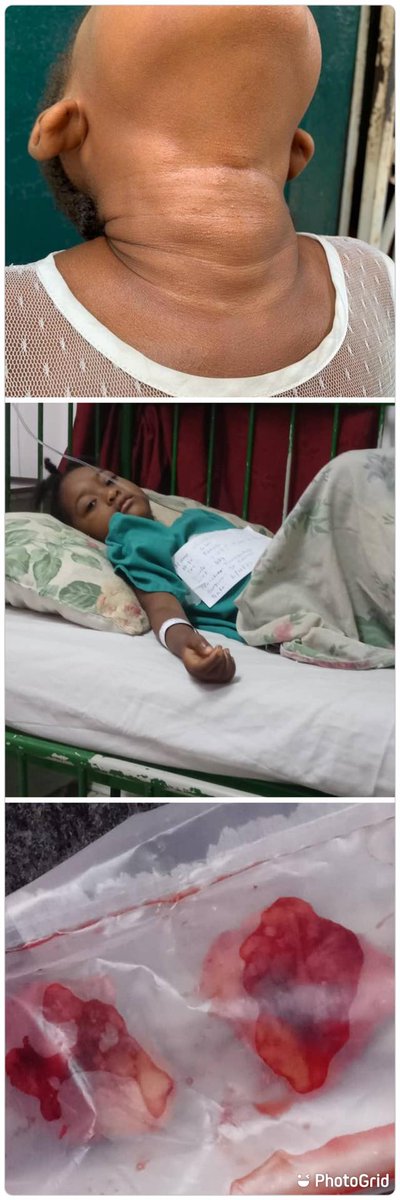 PikinSick's tweet photo. Some time in May we brought to the general public the case Christiana Kelfale who was diagnosed with Tonsillitis at age two. She had hard time breathing, the family assumed she had asthma. She was taken to the hospital and was later given medications amd treatments as one does an https://t.co/AzWEZZismu