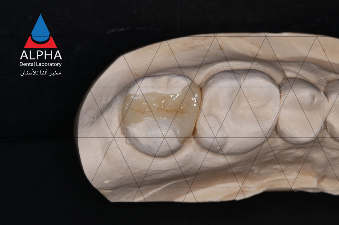 Taking a closer look at Emax Press Inlay! 💎✨
This dental masterpiece combines precision and beauty, giving your smile the attention, it deserves. 😁💫
