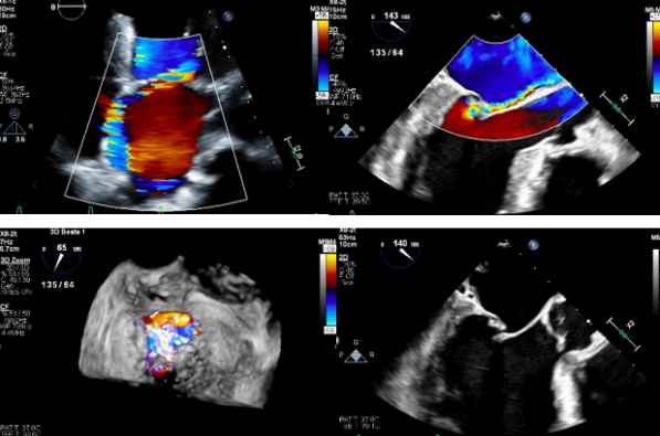 Watch Live M-TEER in High Risk Patient with Primary MR Secondary to Flail & Prolapse P2 ccclivecases.org/live-webcast/ #CardioTwitter #mitraclip #structuralheart #Cardiology #interventionalcardiology