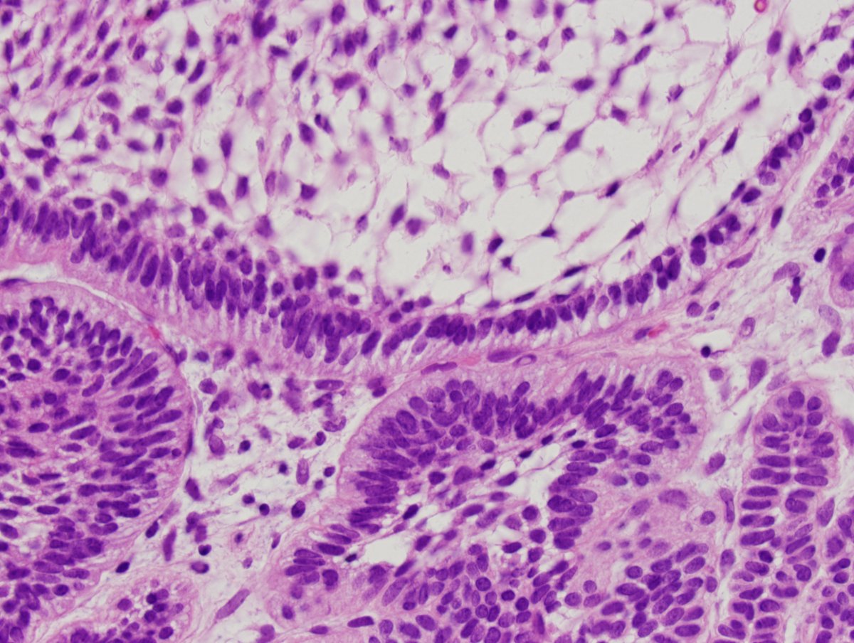 One of the most pathognomonic histologic findings for a tumor entity. This is Ameloblastic Fibroma. #surgpath #pathtwitter #pathology #pathologists #ENT