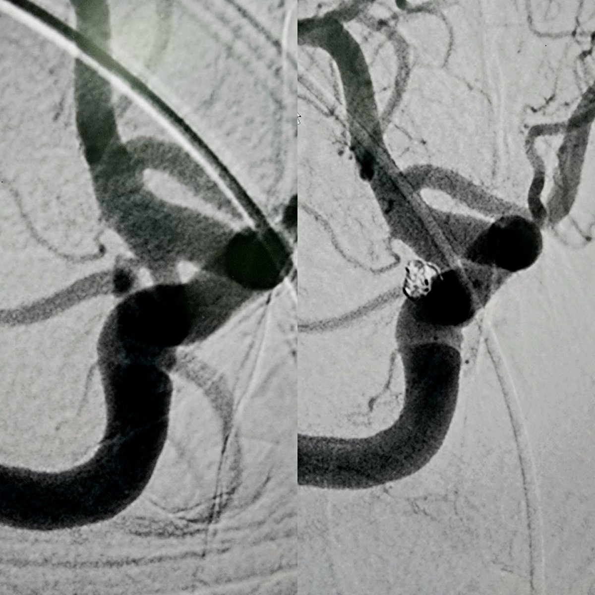 SSN_IR's tweet photo. Two days and two lives saved...
Pcom aneurysm unassisted coiling and post -stab injury  intercostal artery psudoaneurysm embolizations
@Rishabh2970 @ISVIRIndia @ccare https://t.co/5ZpI0n5u1V