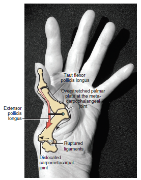 6⃣ Curiosidades sobre la #Inervación y #Ligamentos del Pulgar!

Región altamente inervada que depende de un correcto trabajo Neuromuscular y propioceptivo de la musculatura.

¿Conoces estos 6?🙄⬇️