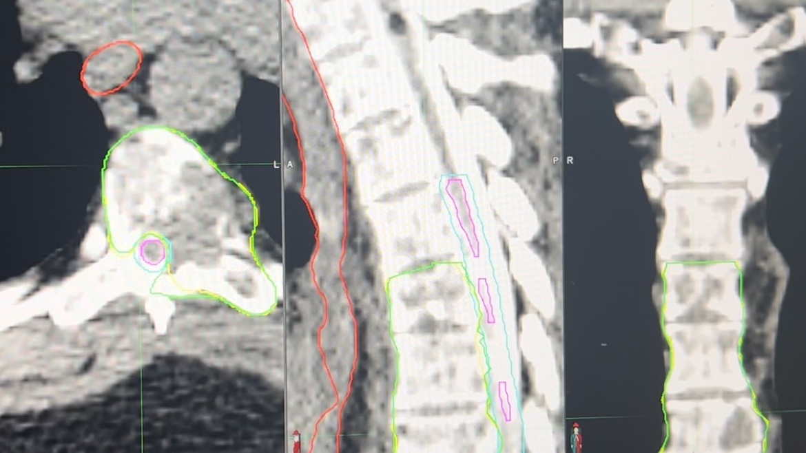 TheDrWood's tweet image. Grateful for our work examining the success of peer-to-peer authorization strategies highlighting @NCCN guideline-cited Level 1 evidence in reversing insurance denials for spine #SBRT being published in @AJCOonline! #KillCancer #FixPriorAuth #SPORTSMEN
journals.lww.com/amjclinicalonc…