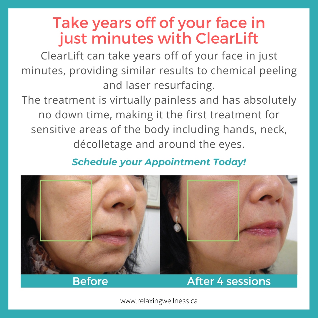 ClearLift can take years off of your face in just minutes, providing similar results to chemical peeling and laser resurfacing.💙
It is virtually painless and has no down time, which is perfect  for sensitive areas of the body: hands, neck, décolletage and around the eyes.