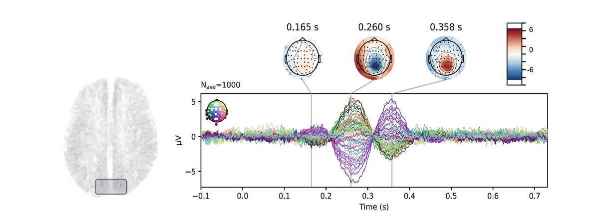 ML for brain disorders: one chapter / day

EEG and MEG are cornerstone modalities in brain disorders! They allow to measure evoked activity, oscillations, functional connectivity…

Chapter by <a href="/MConstanceCorsi/">Marie-Constance Corsi</a> <a href="/AramisLabParis/">ARAMISLAB</a> 
link.springer.com/protocol/10.10…