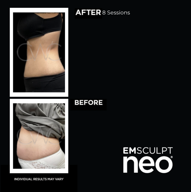 CWCMedSpa's tweet photo. Our patient saw incredible results with #EMSCULPTNEO🔥
Call us for a consult at 586-307-2109
#bodycontouring #bodysculpting #beforeandafter #results #emsculptexperience #lessfat #moremuscle #fatreduction #abs #noninvasive #nonsurgical #medspa #michiganmedspa https://t.co/KhehXcrP6h