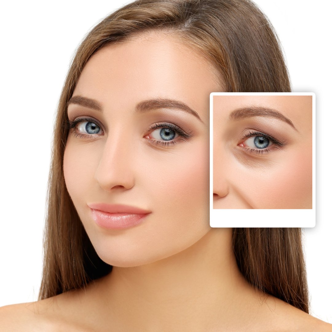 How Do I Prepare for My Blepharoplasty Eyelid Surgery?

See more: 1l.ink/5N6DTNN

#AdvancedCosmeticSurgeryandLaserCenter #351Face #Botox #CosmeticSurgeon #Cincinnati #Ohio #PlasticSurgeon #MedicalSpa #Skincare #Injectables #LaserTreatments #EyelidSurgery #Blepharoplasty