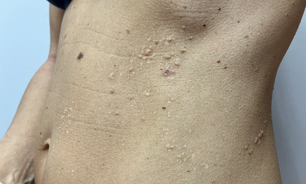 allobe86's tweet photo. Paciente con lesiones lineales en abdomen en forma de pápulas pruriginosas.♾️
¿En qué piensas?
#dermatología #dermatology #dermatologytips #ENARM23 #ENARM24 #MIR24 #dermaquiz https://t.co/LebkZlNmZN