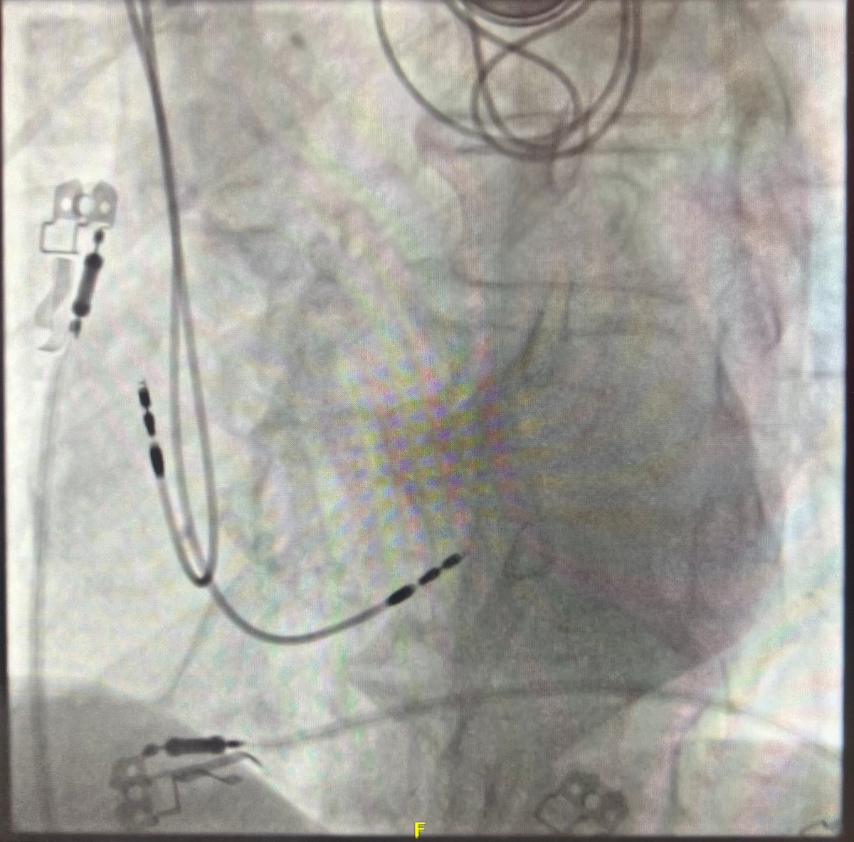 ⚡️🫀Honored to have had the chance today to implant with Dr Overeinder the #AmviaSky: the first PM approved for LBBAP.
Very grateful to @deasnostos and all the @HRMCBrussel team of for making this happen. @UZBrussel @BIOTRONIK_News @BIOTRONIK_US